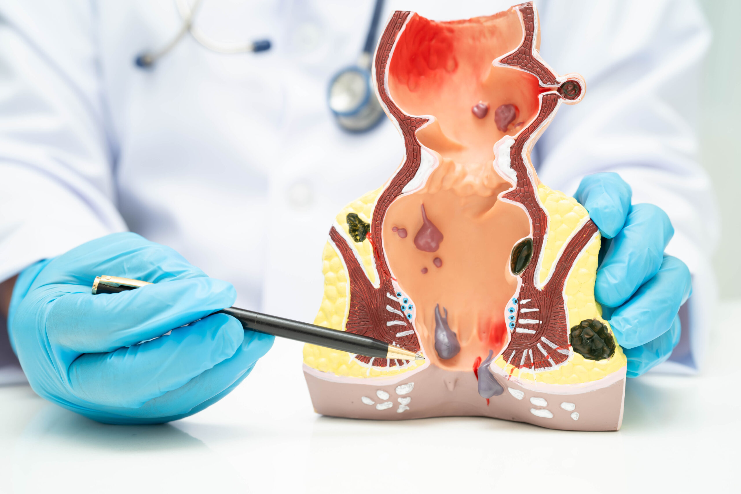 Asian doctor with rectum and hemorrhoid human anatomy model at hospital, inflamed vascular structure.
